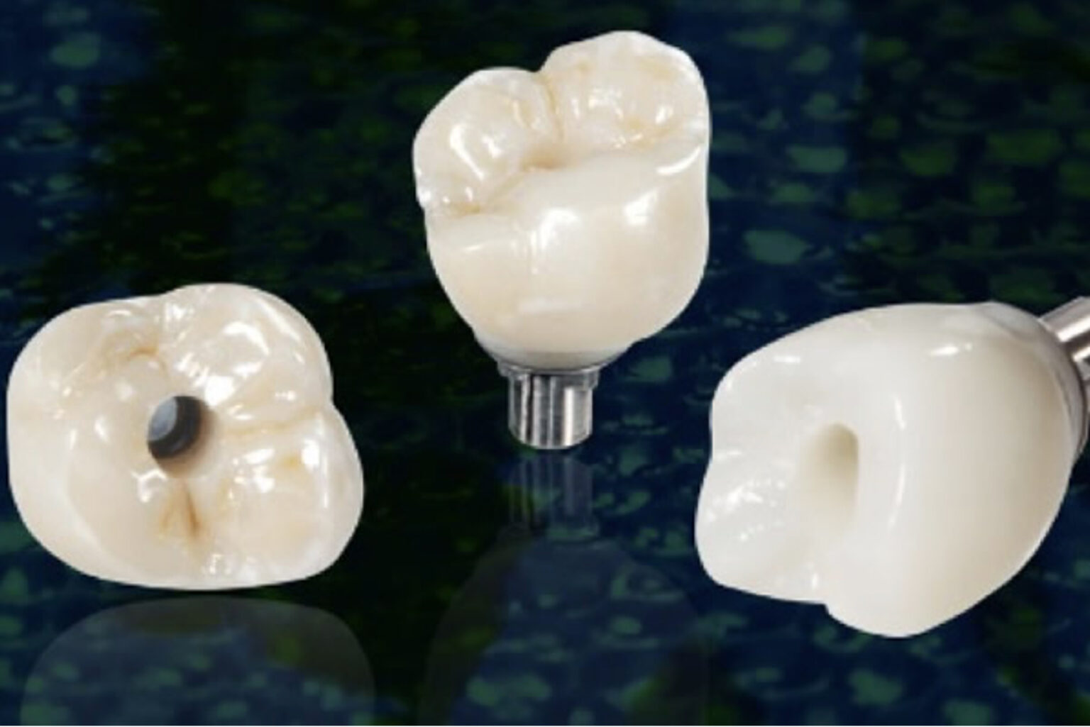 Couronne transvissée sur implant SIVP DENTAIRE